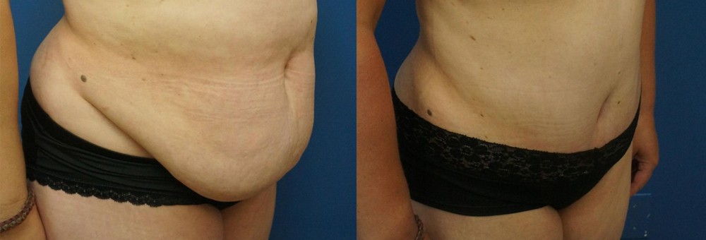 Tummy Tuck