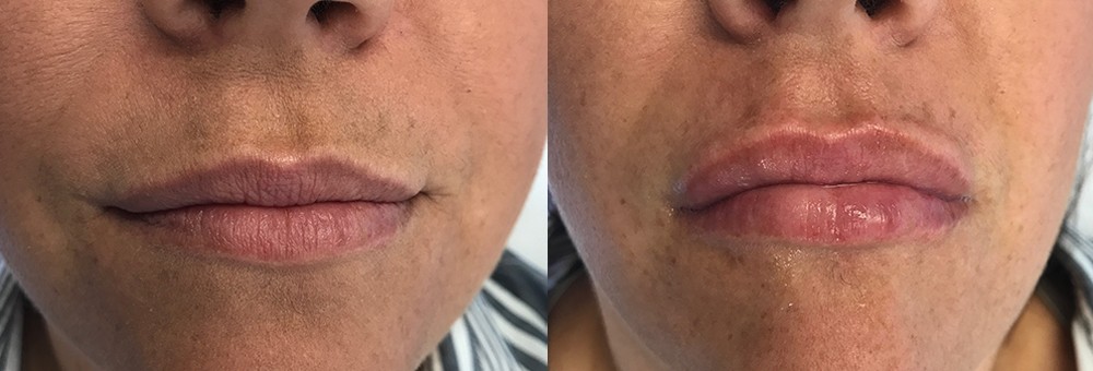 LakeshoreDerm Lips Experts