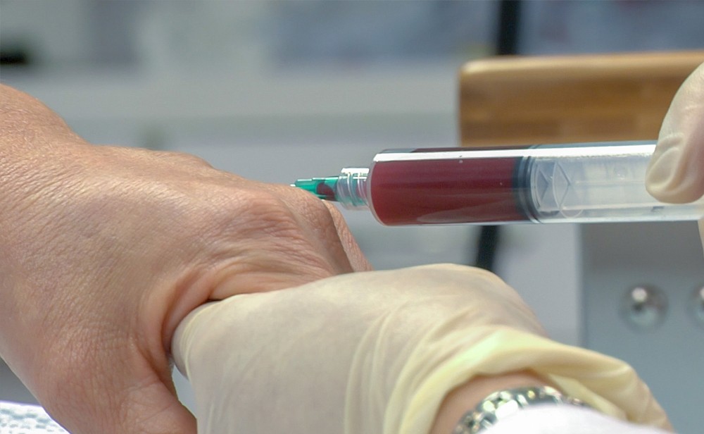 Platelet Rich Plasma