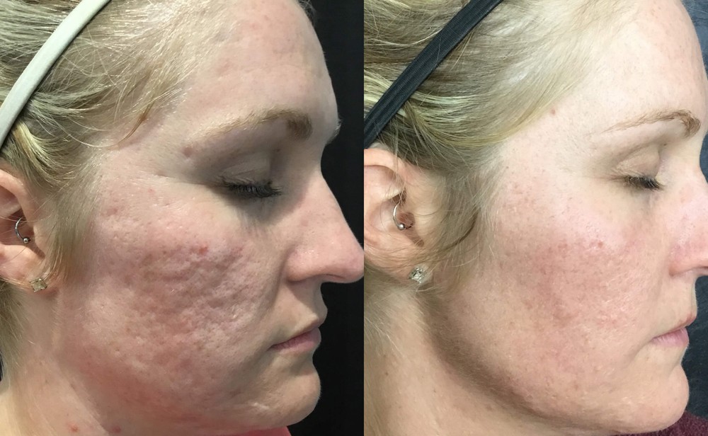 Microneedling