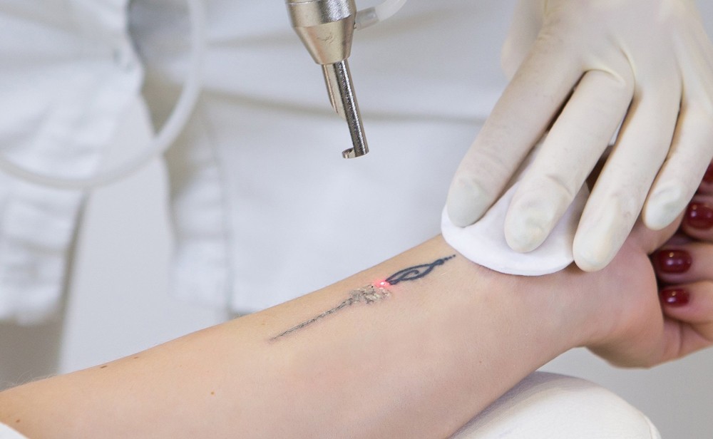 Tattoo-Removal