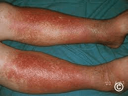 Cutaneous Candidiasis