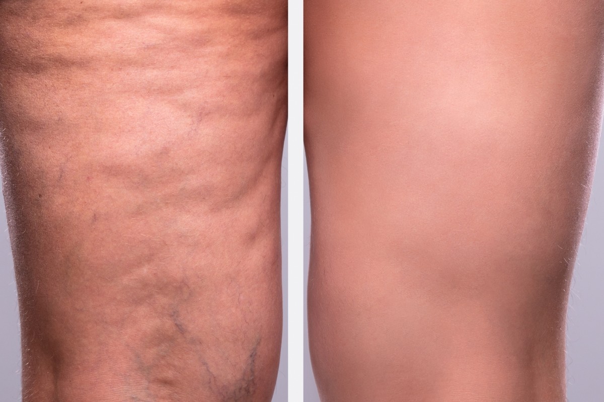 Optimized Laser Vein Removal