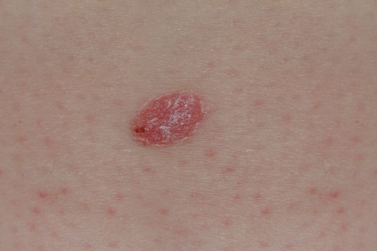 Optimized-Psoriasis