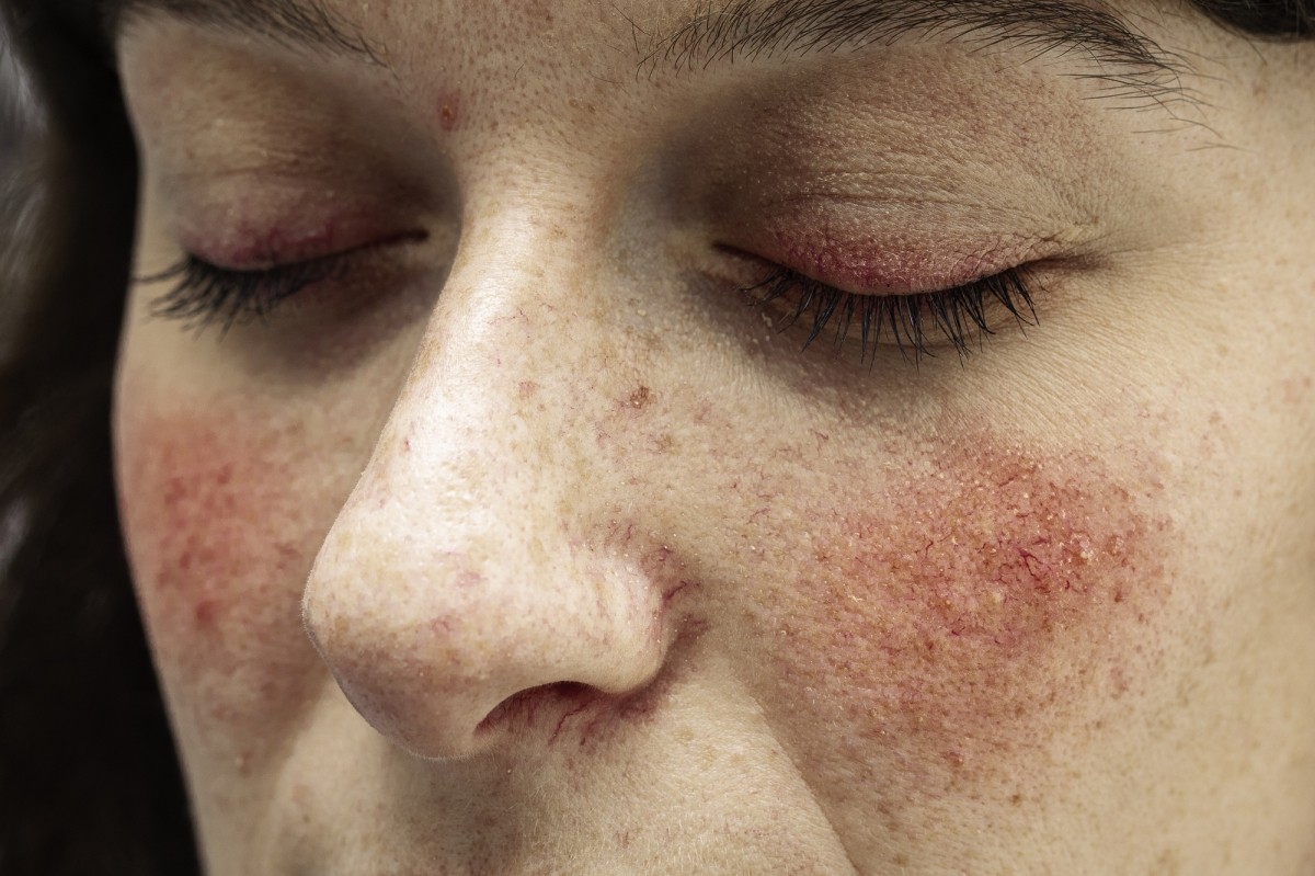 Optimized-Rosacea