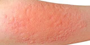 Contact Dermatitis Treatments | SLO | Coastal Dermatology